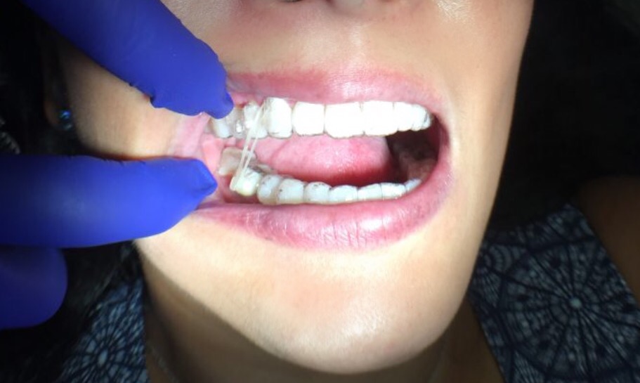 teeth2