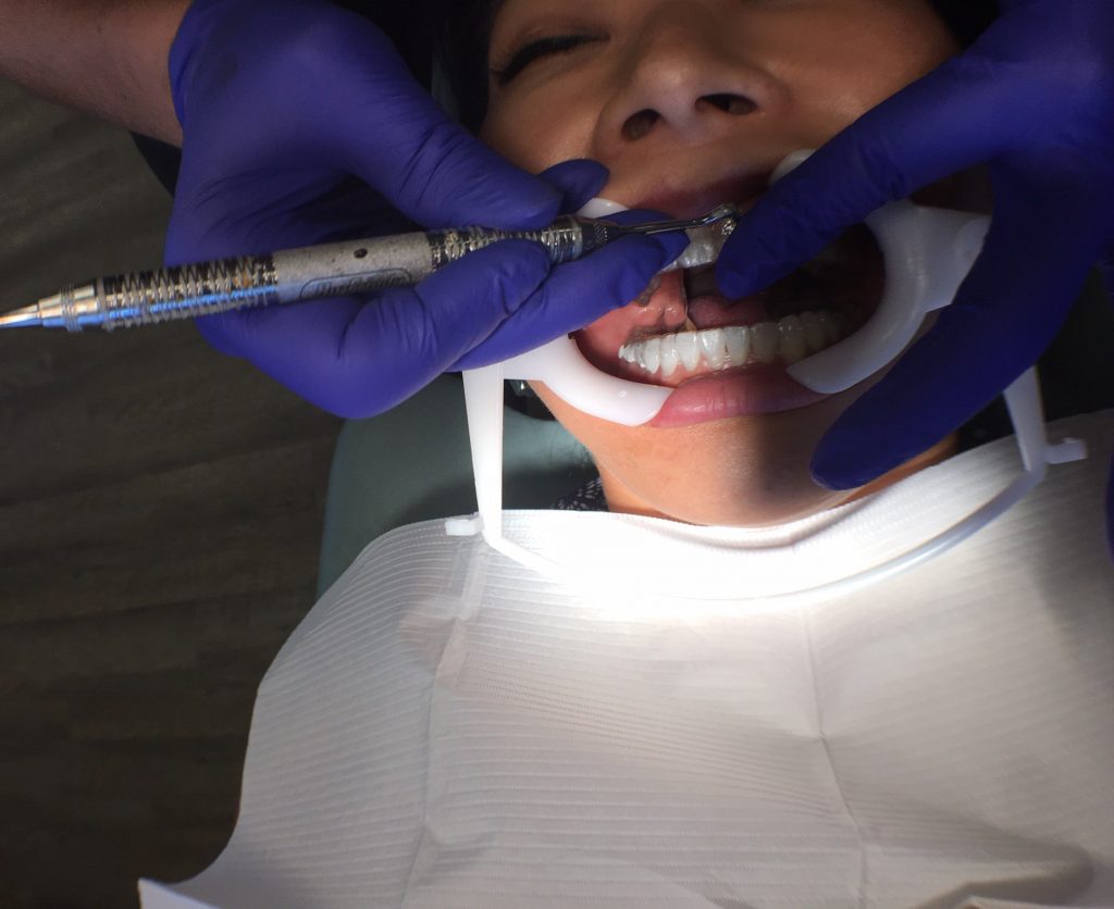 installing invisalign attachmets in the invisalign process