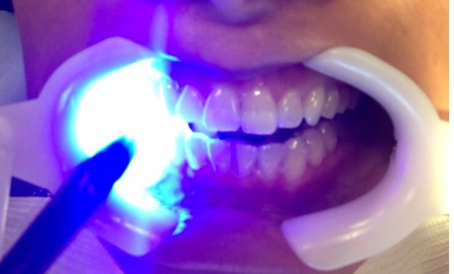 getting invisalign attachments installed