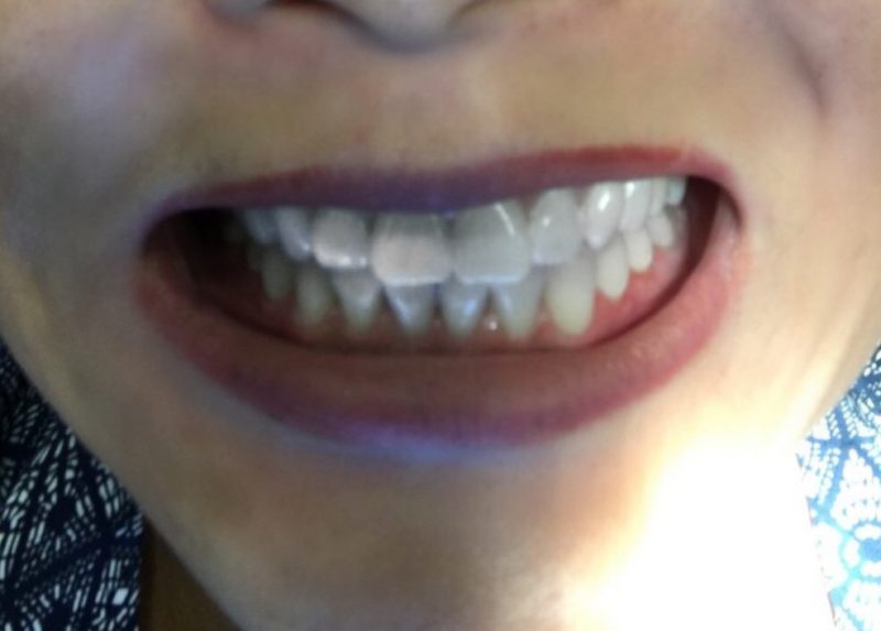 teeth before invisalign