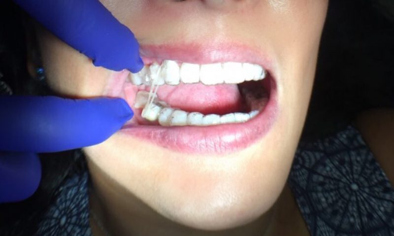 teeth with rubber band straightener during Invisalign process