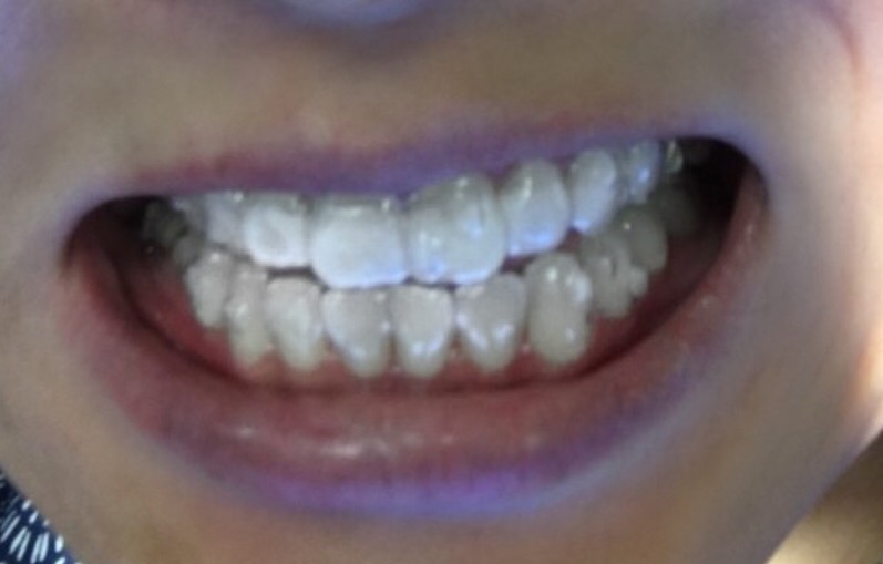 teeth with invisalign on