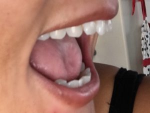 Invisalign status picture after 5 months
