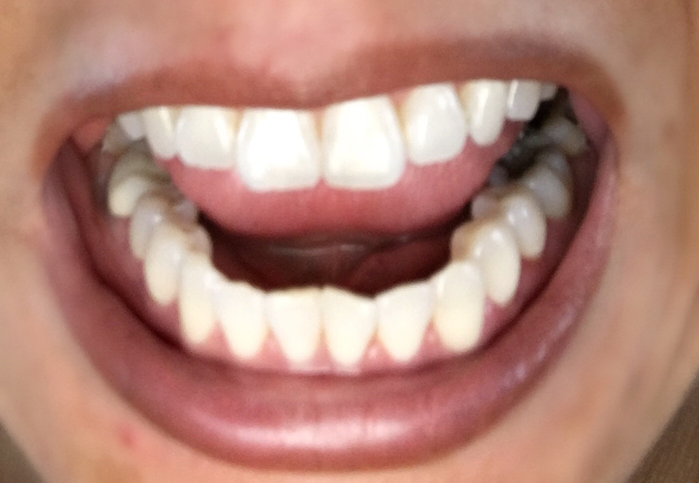 Invisalign Experiences What They Don't Tell You Ounce of Salt