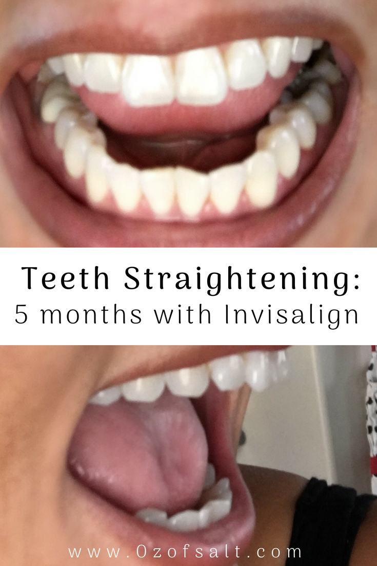 Learn all about the aftermath of Invisalign Teeth Straightening! I reveal everything they DON'T tell you about this popular cosmetic teeth straightening experience. #ozofsalt #teethstraightening #beautyblogger